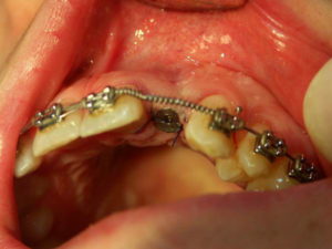 implanty zębów poznań
