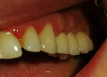 implanty zębów poznań